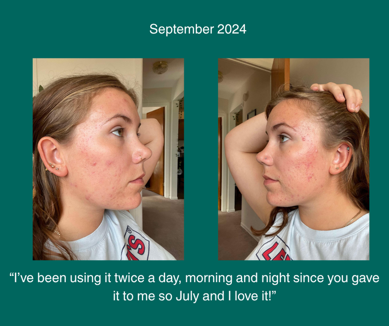 Two images of a woman with text about using Thalasso Restore product daily since July. This is the before photo.